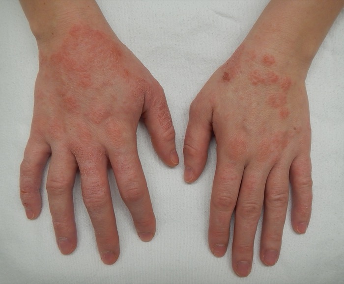 Eczema (dermatitis) on the backs of the hands