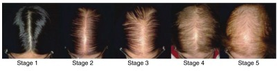 Stages of pattern hair thinning