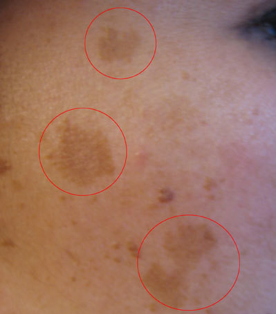 Melasma pigmentation patches on the cheek