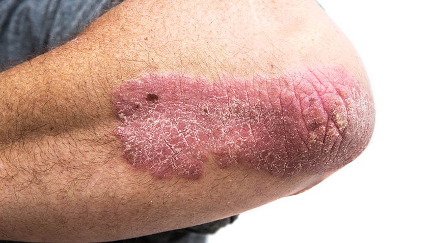 Psoriasis plaque on the elbow, showing raised red skin with silvery scale