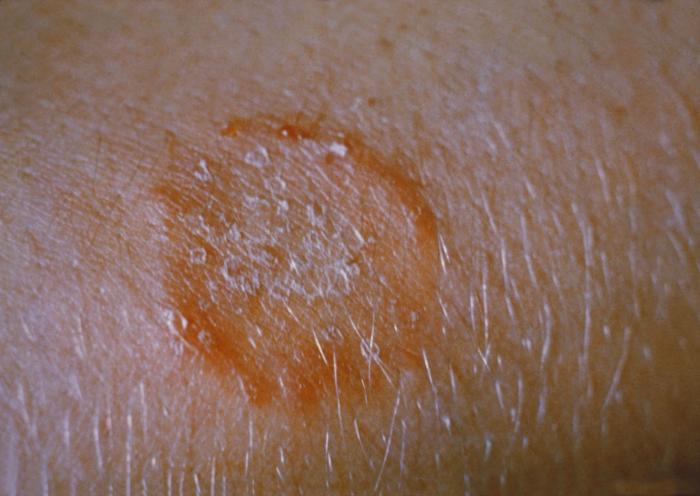 Ringworm (tinea corporis) lesion on the forearm